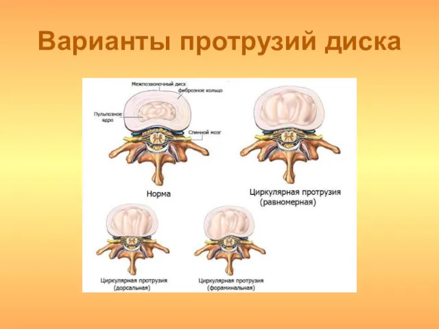 Варианты протрузий диска