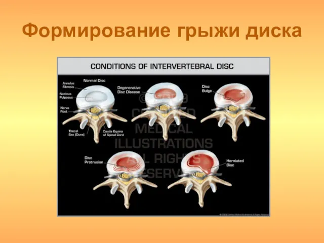 Формирование грыжи диска