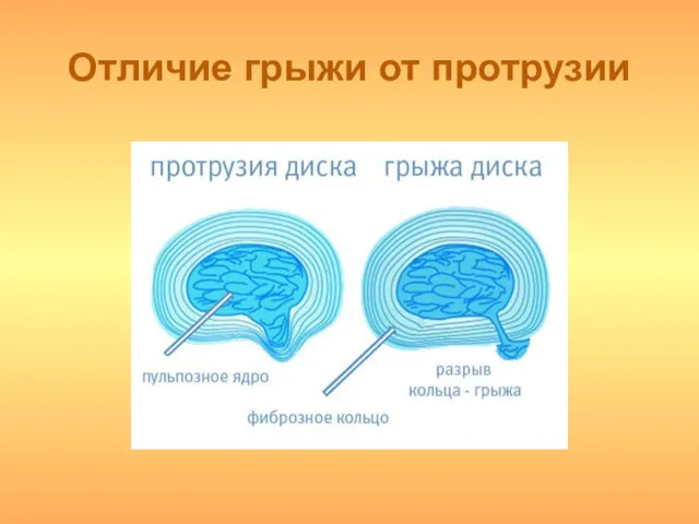 Отличие грыжи от протрузии