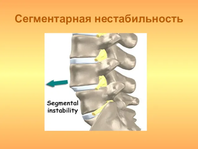 Сегментарная нестабильность