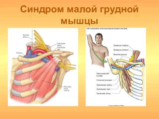 Синдром малой грудной мышцы