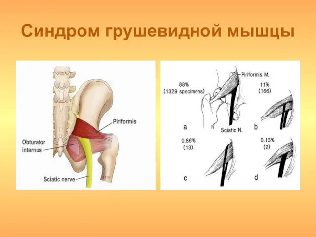 Синдром грушевидной мышцы