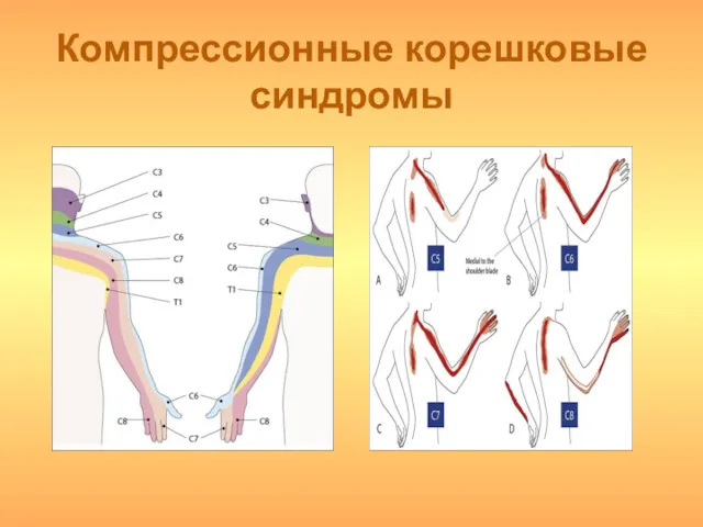 Компрессионные корешковые синдромы