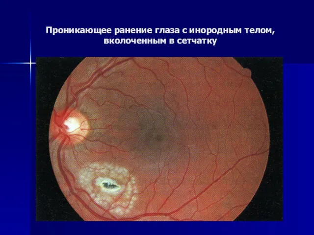 Проникающее ранение глаза с инородным телом, вколоченным в сетчатку