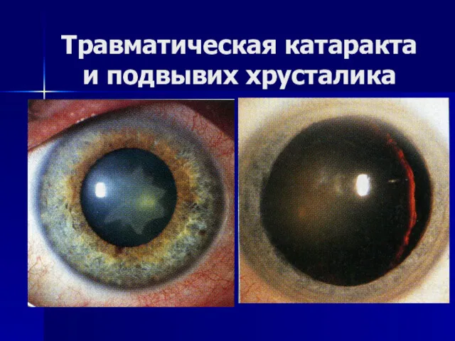 Травматическая катаракта и подвывих хрусталика
