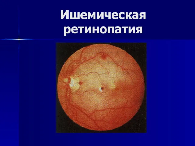 Ишемическая ретинопатия