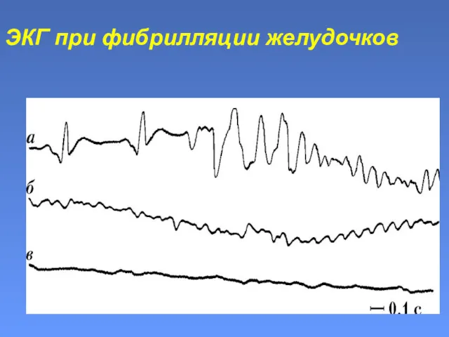 ЭКГ при фибрилляции желудочков