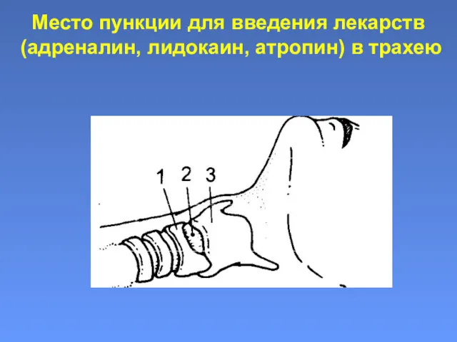 Место пункции для введения лекарств (адреналин, лидокаин, атропин) в трахею