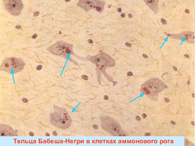 Тельца Бабеша-Негри в клетках аммонового рога