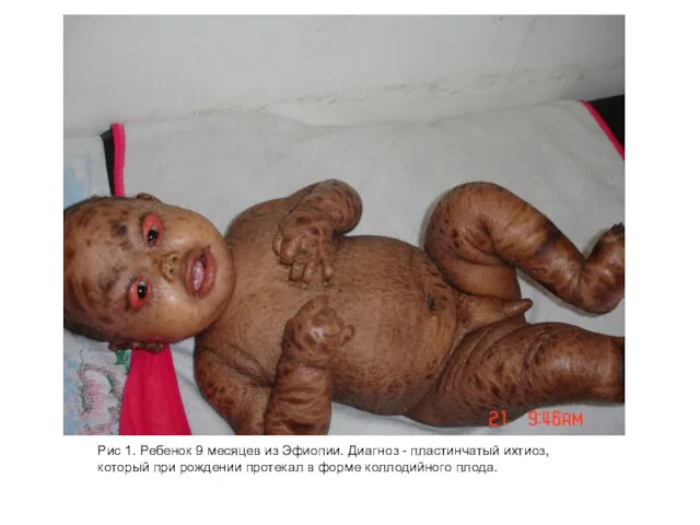 Рис 1. Ребенок 9 месяцев из Эфиопии. Диагноз - пластинчатый