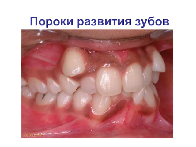 Пороки развития зубов