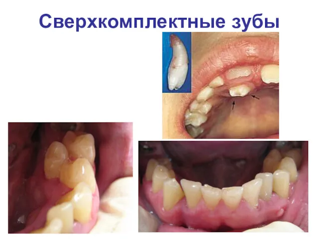 Сверхкомплектные зубы Адентия 12 и 22 зубов