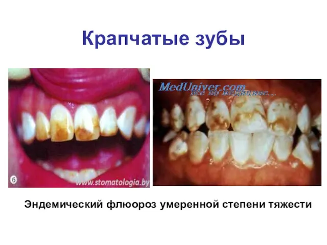 Крапчатые зубы Эндемический флюороз умеренной степени тяжести