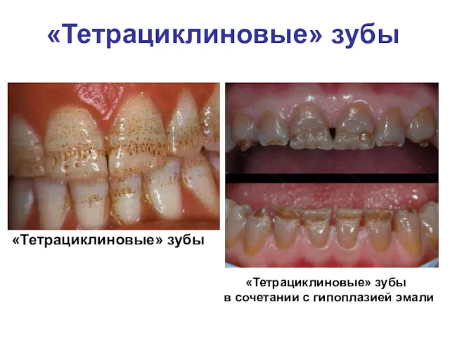«Тетрациклиновые» зубы «Тетрациклиновые» зубы «Тетрациклиновые» зубы в сочетании с гипоплазией эмали