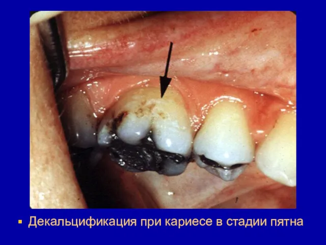Декальцификация при кариесе в стадии пятна
