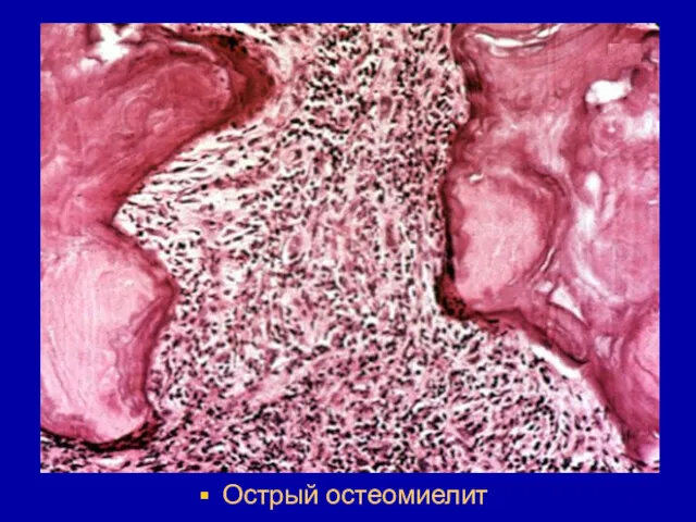 Острый остеомиелит