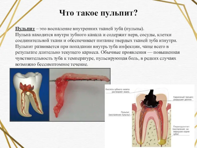 Что такое пульпит? Пульпит – это воспаление внутренних тканей зуба (пульпы). Пульпа находится