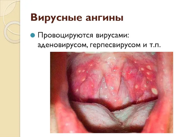 Вирусные ангины Провоцируются вирусами: аденовирусом, герпесвирусом и т.п.