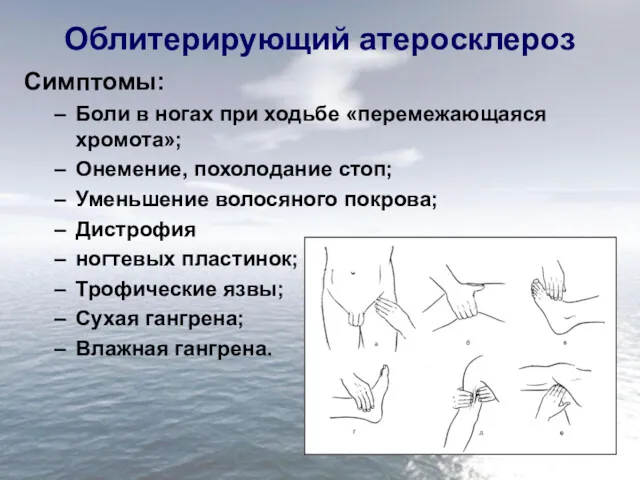 Облитерирующий атеросклероз Симптомы: Боли в ногах при ходьбе «перемежающаяся хромота»;