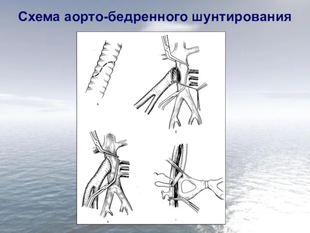 Схема аорто-бедренного шунтирования