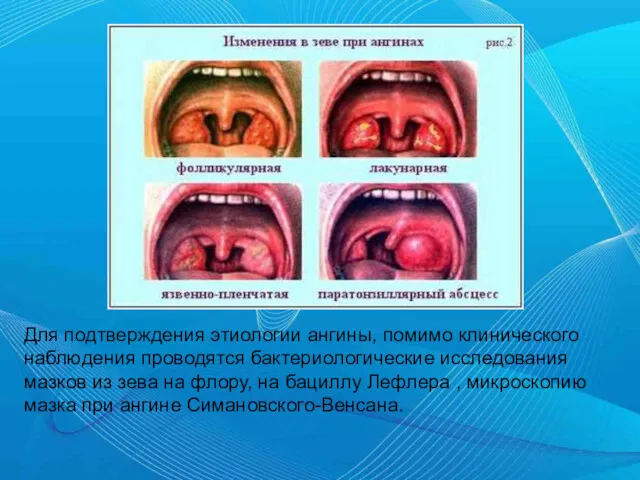 Для подтверждения этиологии ангины, помимо клинического наблюдения проводятся бактериологические исследования