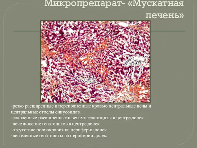 Микропрепарат- «Мускатная печень» -резко расширенные и переполненные кровью центральные вены и центральные отделы