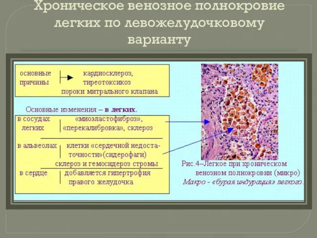 Хроническое венозное полнокровие легких по левожелудочковому варианту