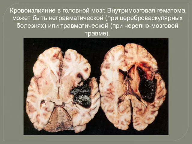 Кровоизлияние в головной мозг. Внутримозговая гематома, может быть нетравматической (при цереброваскулярных болезнях) или