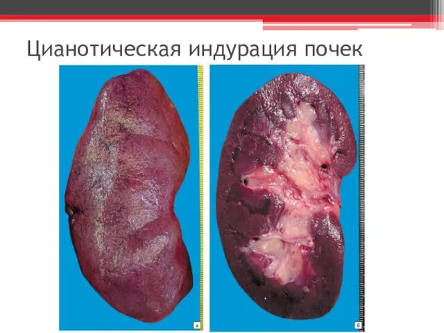 Цианотическая индурация почек