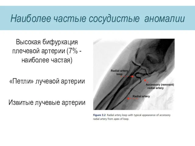 Наиболее частые сосудистые аномалии Высокая бифуркация плечевой артерии (7% -наиболее частая) «Петли» лучевой