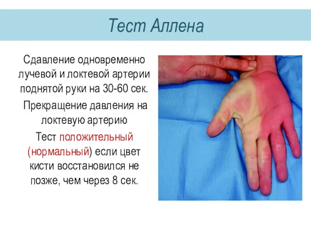 Тест Аллена Сдавление одновременно лучевой и локтевой артерии поднятой руки на 30-60 сек.