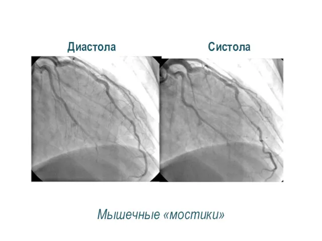 Систола Диастола Мышечные «мостики»