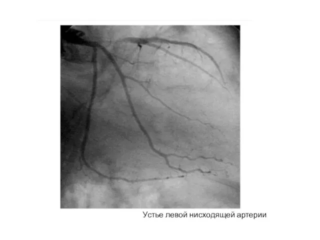 Устье левой нисходящей артерии