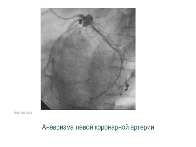 Аневризма левой коронарной артерии