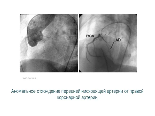 Аномальное отхождение передней нисходящей артерии от правой коронарной артерии