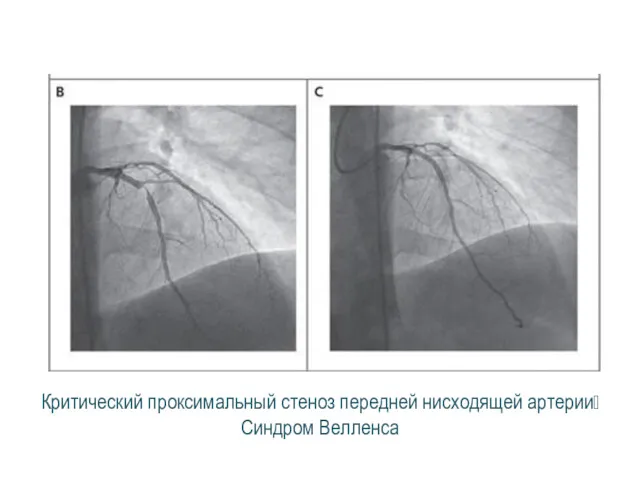 Критический проксимальный стеноз передней нисходящей артерии? Синдром Велленса