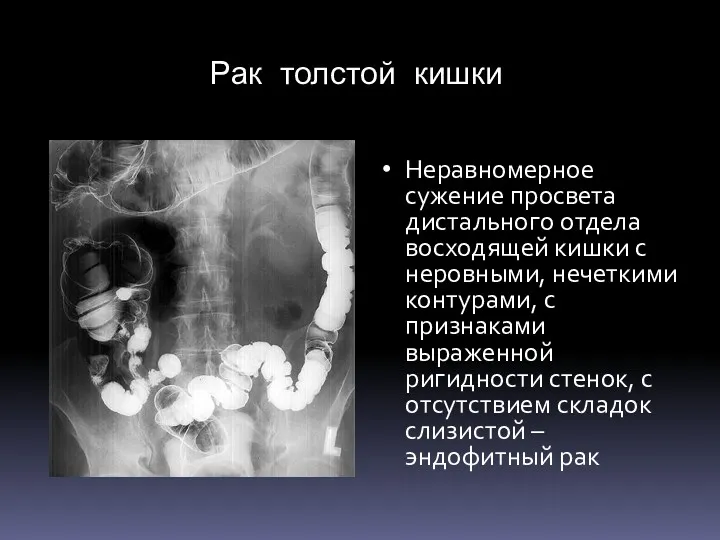 Рак толстой кишки Неравномерное сужение просвета дистального отдела восходящей кишки