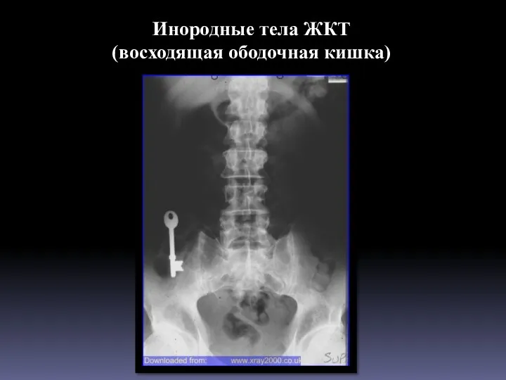 Инородные тела ЖКТ (восходящая ободочная кишка)