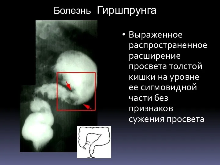 Болезнь Гиршпрунга Выраженное распространенное расширение просвета толстой кишки на уровне