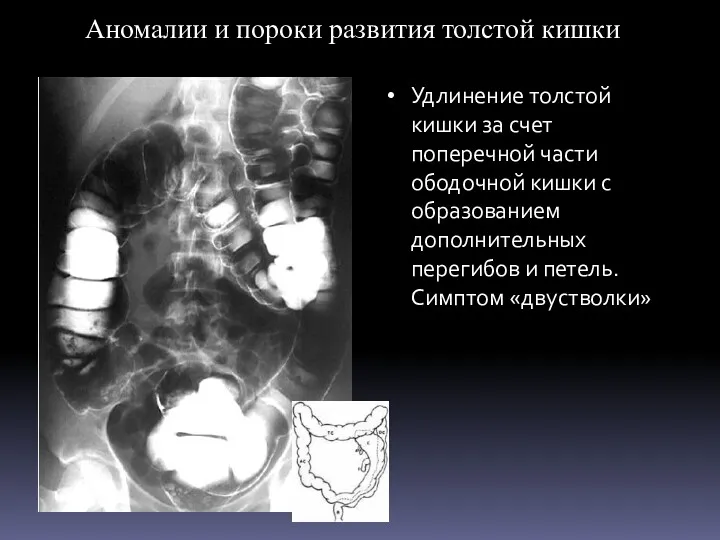 Аномалии и пороки развития толстой кишки Удлинение толстой кишки за