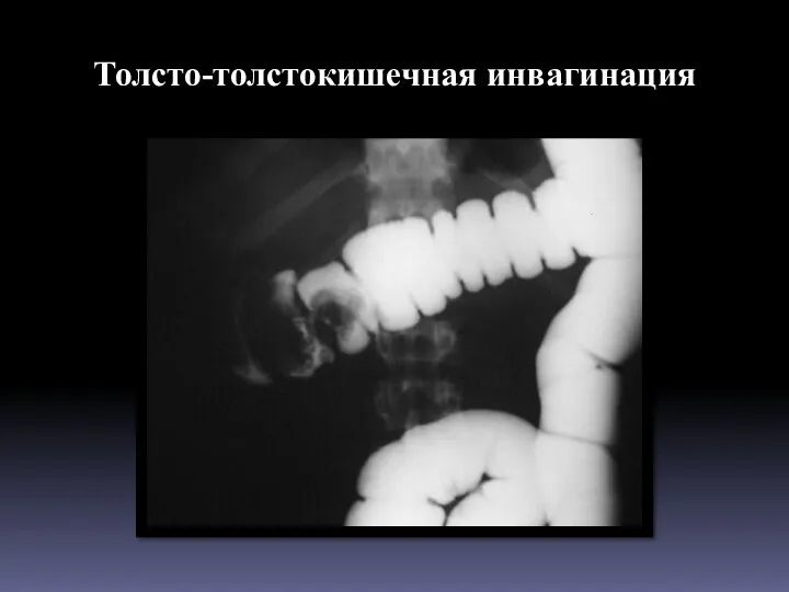 Толсто-толстокишечная инвагинация