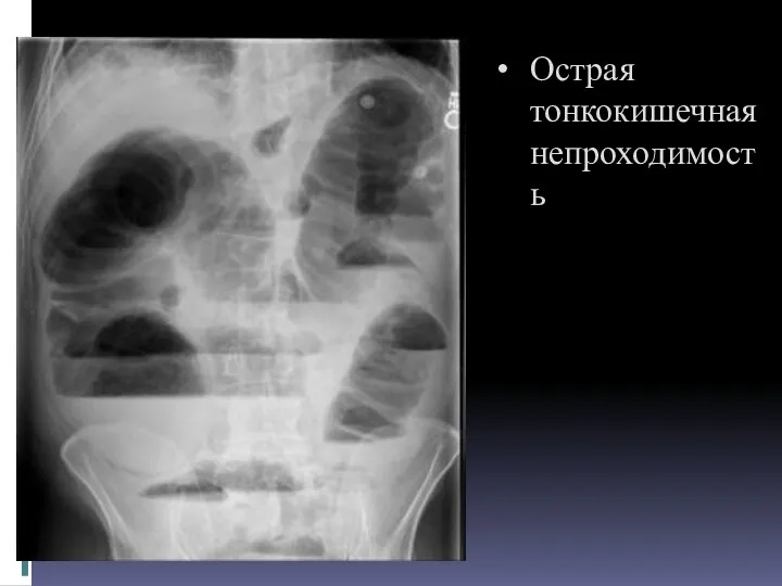 Острая тонкокишечная непроходимость