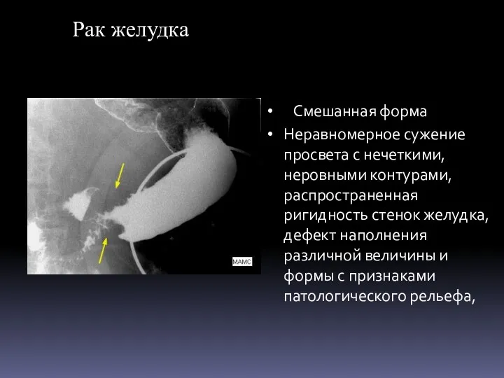 Рак желудка Смешанная форма Неравномерное сужение просвета с нечеткими, неровными