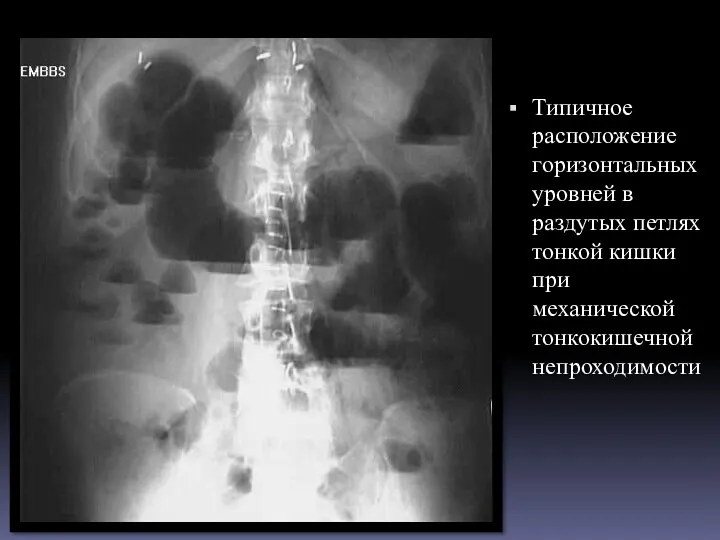 Типичное расположение горизонтальных уровней в раздутых петлях тонкой кишки при механической тонкокишечной непроходимости