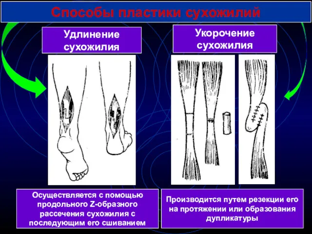 Способы пластики сухожилий Удлинение сухожилия Укорочение сухожилия Осуществляется с помощью