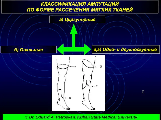 КЛАССИФИКАЦИЯ АМПУТАЦИЙ ПО ФОРМЕ РАССЕЧЕНИЯ МЯГКИХ ТКАНЕЙ г а) Циркулярные