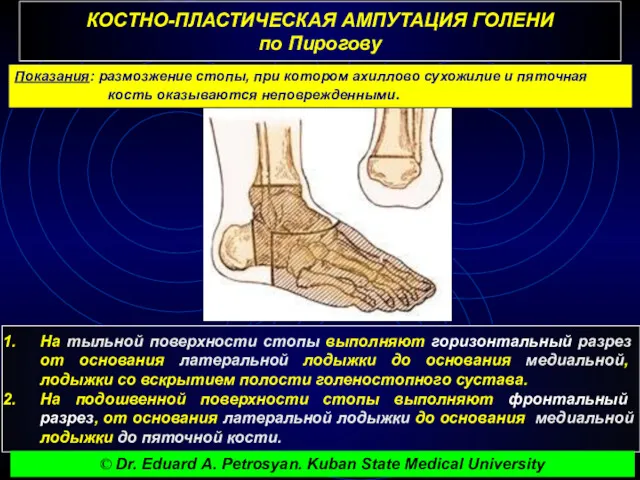 КОСТНО-ПЛАСТИЧЕСКАЯ АМПУТАЦИЯ ГОЛЕНИ по Пирогову Показания: размозжение стопы, при котором