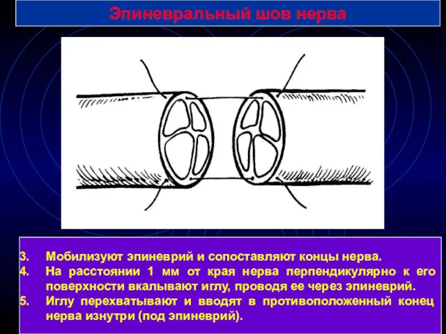 Эпиневральный шов нерва Мобилизуют эпиневрий и сопоставляют концы нерва. На