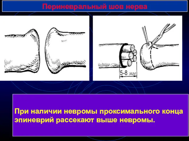 Периневральный шов нерва При наличии невромы проксимального конца эпиневрий рассекают выше невромы.