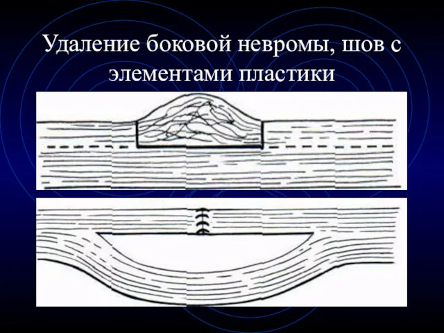 Удаление боковой невромы, шов с элементами пластики